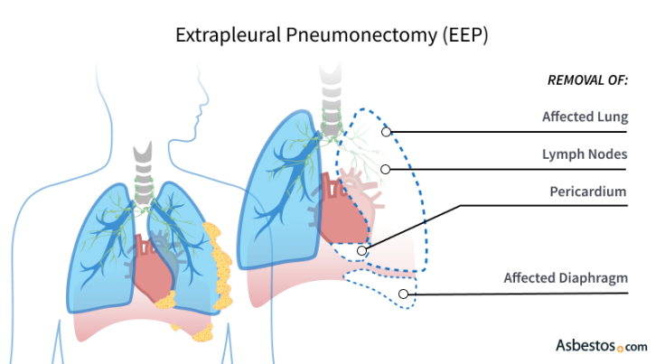 extrapleural pneumonectomy