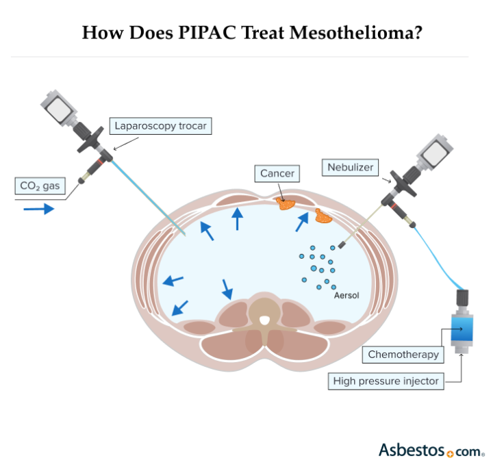How PIPAC treats mesothelioma