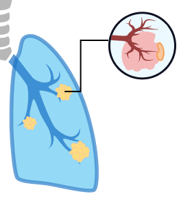 Graphic of lung cancer developing.