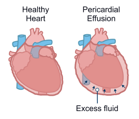Pericardial Effusion