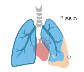Pleural Plaques