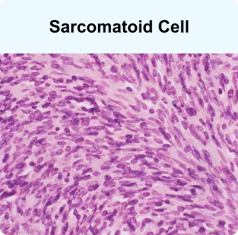 Sarcomatoid mesothelioma cell - elongated spindle shape, the rarest and most aggressive cell type