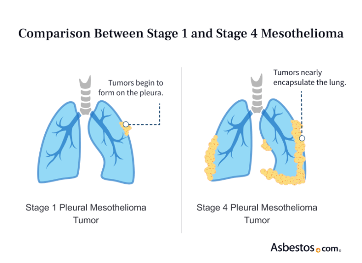 Comparison between stage 1 and stage 4 pleural mesothelioma
