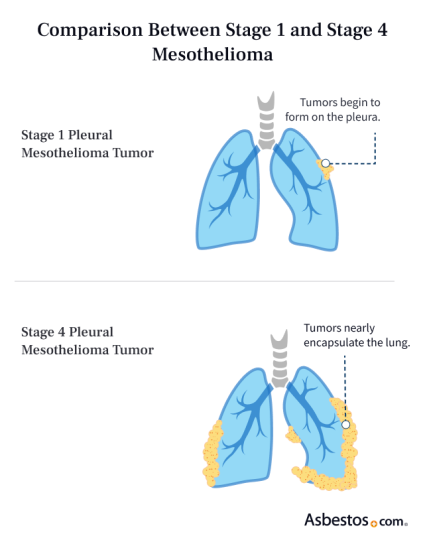 Comparison between stage 1 and stage 4 pleural mesothelioma